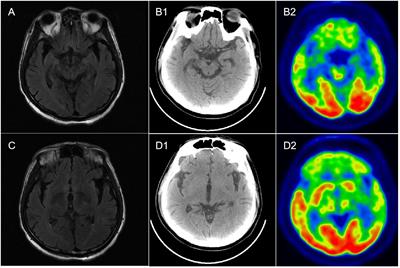 Case report: Ofatumumab treatment in anti-DPPX autoimmune encephalitis